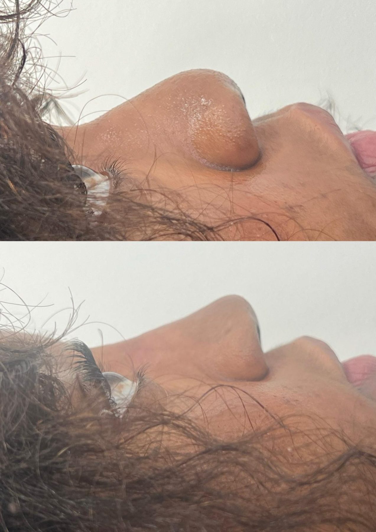 The best Guide to Dermal Fillers: all You Need to Know Before Your Appointment The best Guide to Dermal Fillers: all You Need to Know Before Your Appointment