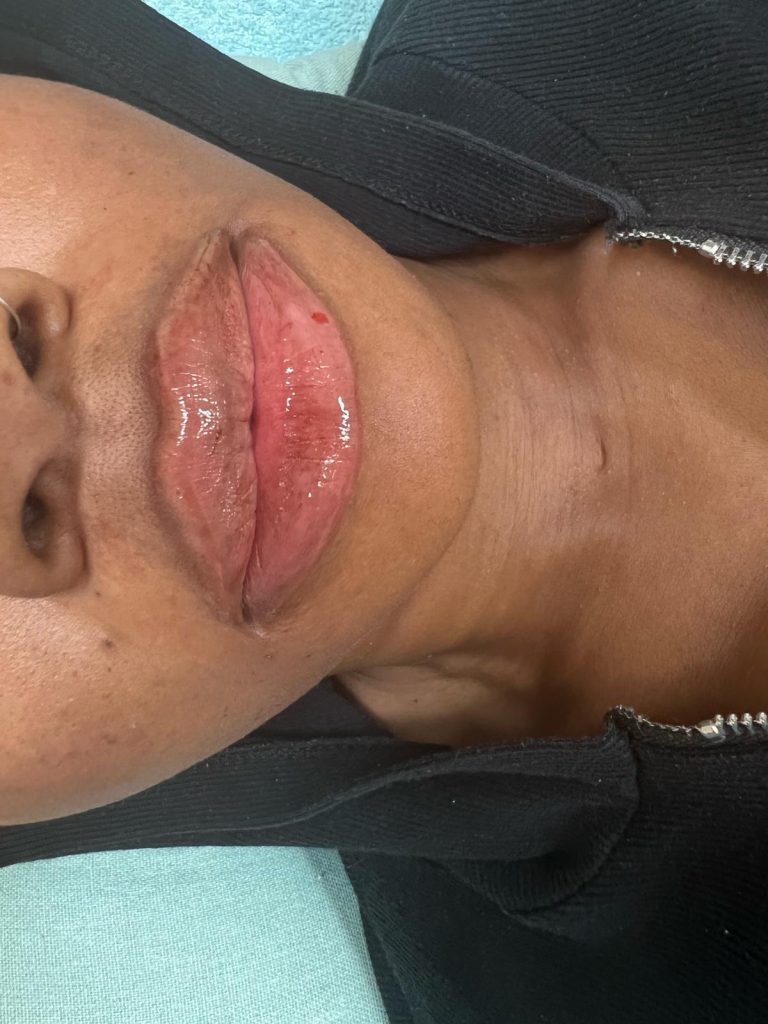 Dermal Fillers Dermal Fillers