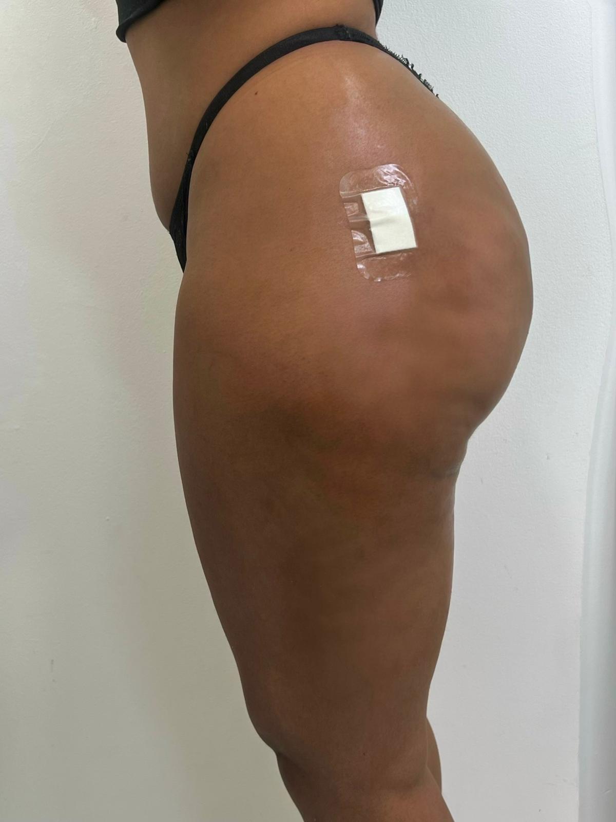 Liquid BBL | Non-Surgical Bum Lift Photo - Side view of a bum after liquid BBL
