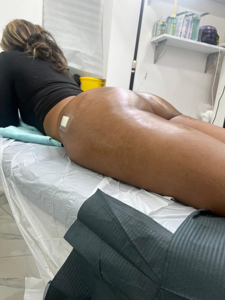 Photo - a woman lying on her stomach in a clinic after having her liquid BBL done, she has 1 needle mark on each side of her bum.

But are liquid bbls safe?