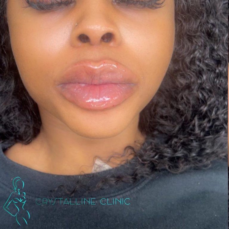 Dermal Fillers Dermal Fillers