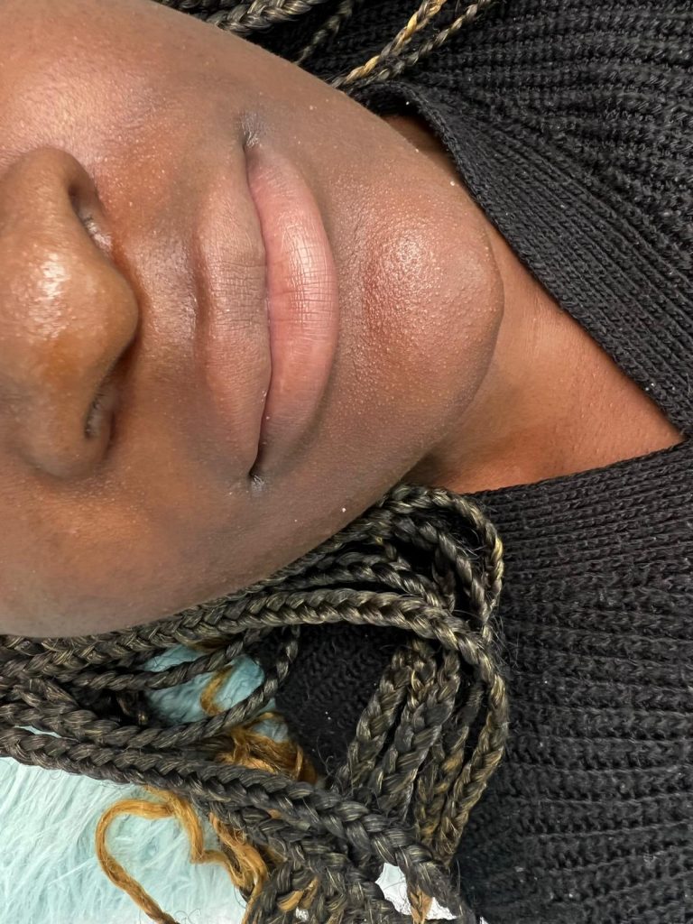 Dermal Fillers Dermal Fillers